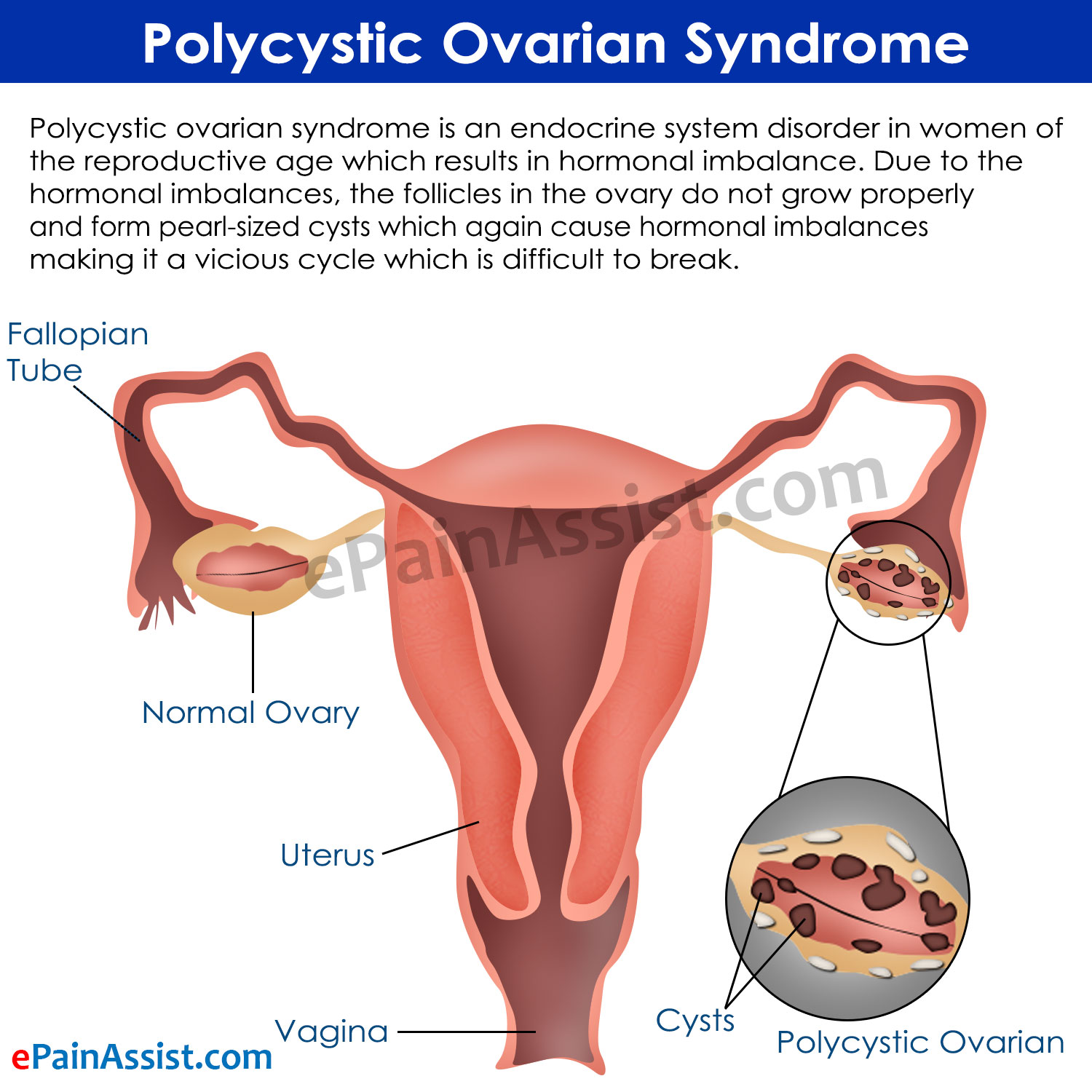 Polycystic ovary syndrome (PCOS) - Mayo Clinic