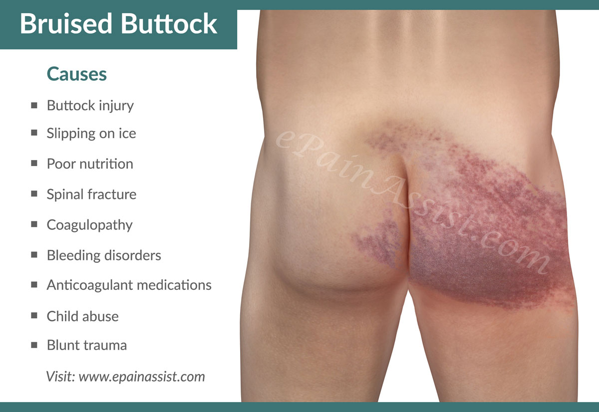 Bruised Butt Bone 56