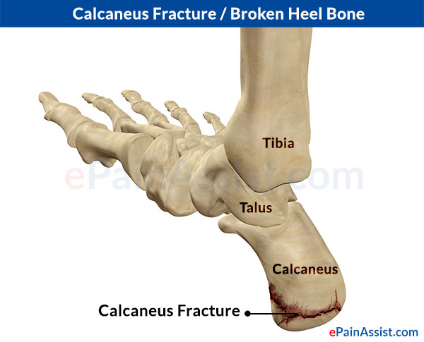 Calcaneus Fracture or Broken Heel|Treatment|Recovery|Symptoms|Types|Causes