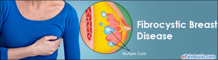 Fibrocystic Breast Disease|Treatment|Causes|Symptoms|Diet