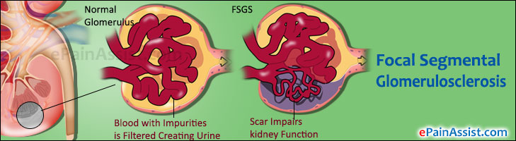 Focal Segmental Glomerulosclerosis (FSGS)CausesSymptoms