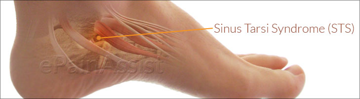 Sinus Tarsi Syndrome|Causes|Symptoms| Treatment|Recovery|Exercises
