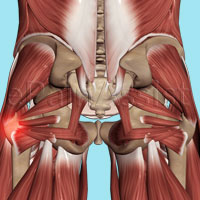 Hip Injuries|Bursitis|Dislocation|Sprain|Tendonitis|Fracture|snapping