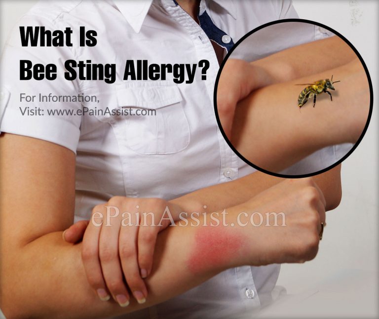What is a Bee Sting Allergy & How is it Treated?