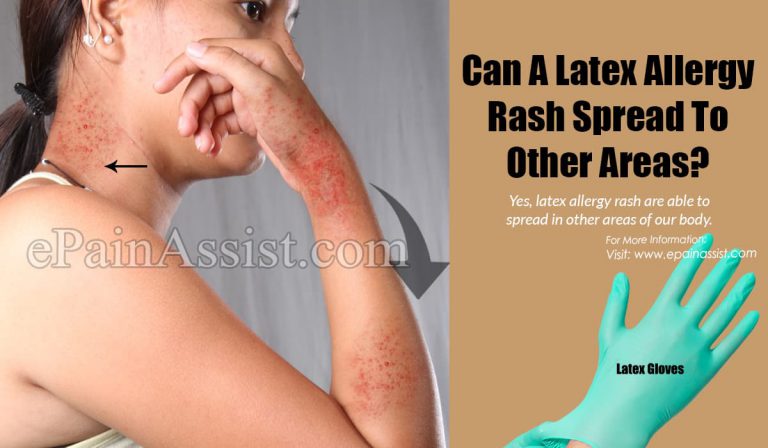 Can A Latex Allergy Rash Spread To Other Areas?