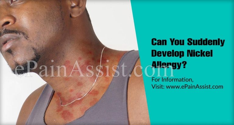 Can You Suddenly Develop Nickel Allergy & How Do I Know If My Jewelry Has Nickel?