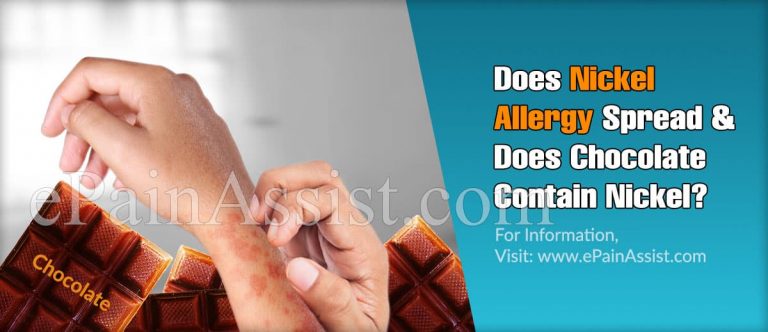 Does Nickel Allergy Spread & Does Chocolate Contain Nickel?