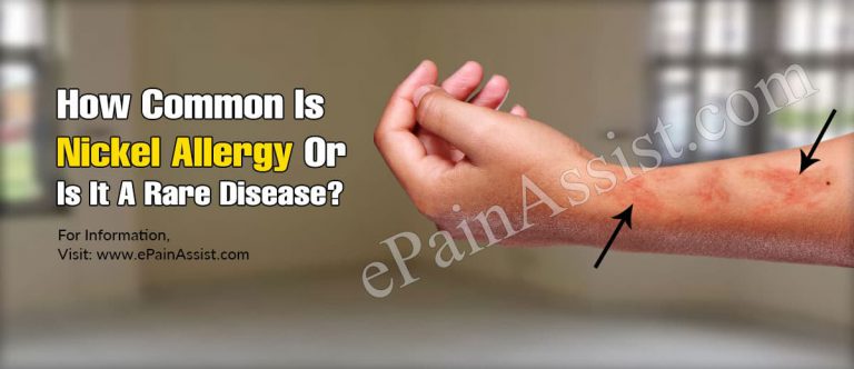 How Common Is Nickel Allergy Or Is It A Rare Disease?