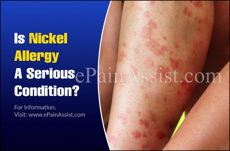 Is Nickel Allergy A Serious Condition & Can It Be Reversed?