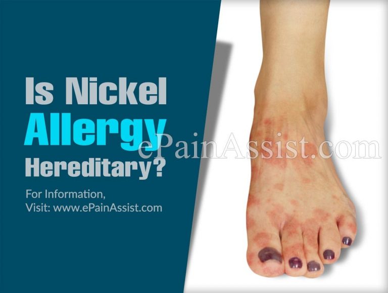 Is Nickel Allergy Hereditary & Does 14k Gold Has Nickel In It?
