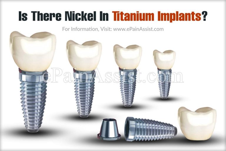Is There Nickel In Titanium Implants & Is Nickel Toxic?