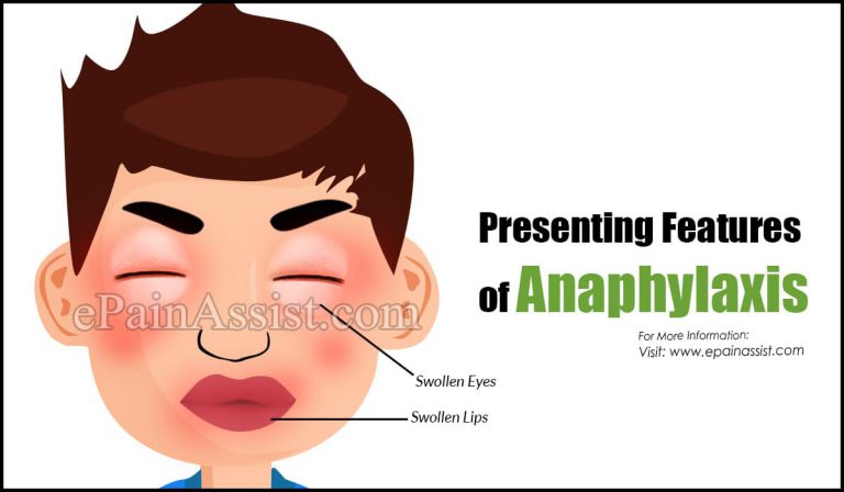 Presenting Features of Anaphylaxis