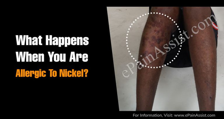 What Happens When You Are Allergic To Nickel & What Is Systemic Nickel Allergy?
