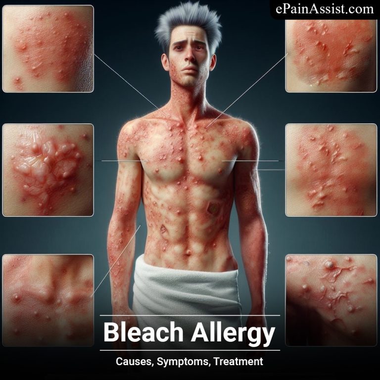 Bleach Allergy: Causes, Symptoms, Treatment
