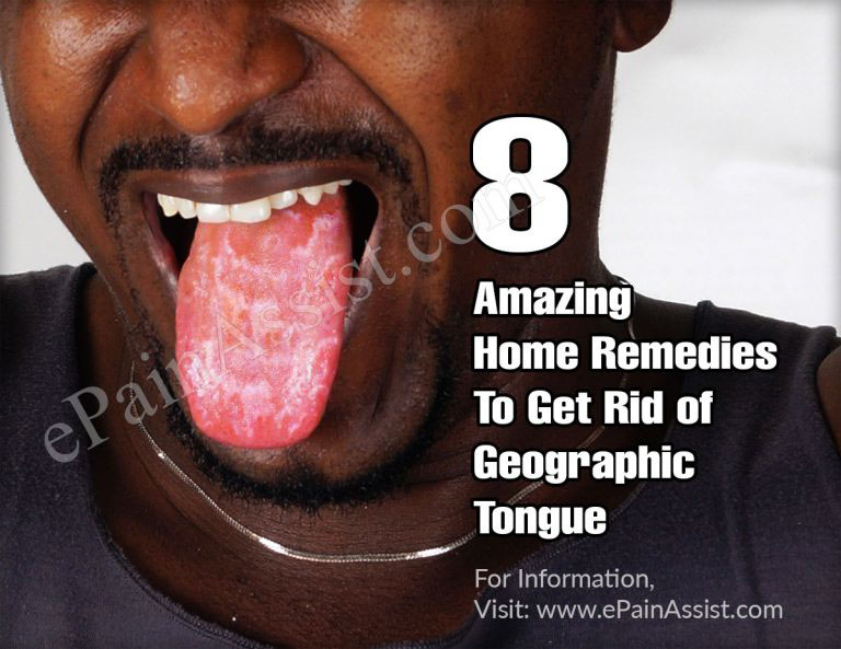 8 Amazing Home Remedies To Get Rid of Geographic Tongue