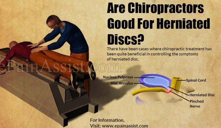 Are Chiropractors Good For Herniated Discs?