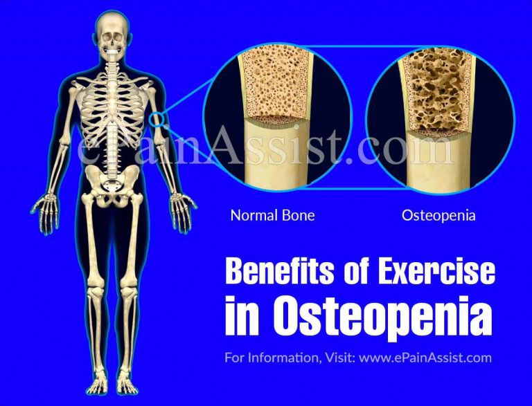 Benefits of Exercise in Osteopenia & Different Types of Weight Bearing Exercises for Osteopenia