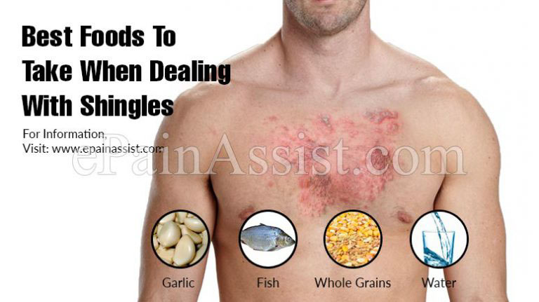 Best Foods To Take When Dealing With Shingles