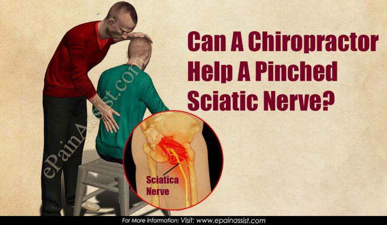 Can A Chiropractor Help A Pinched Sciatic Nerve?