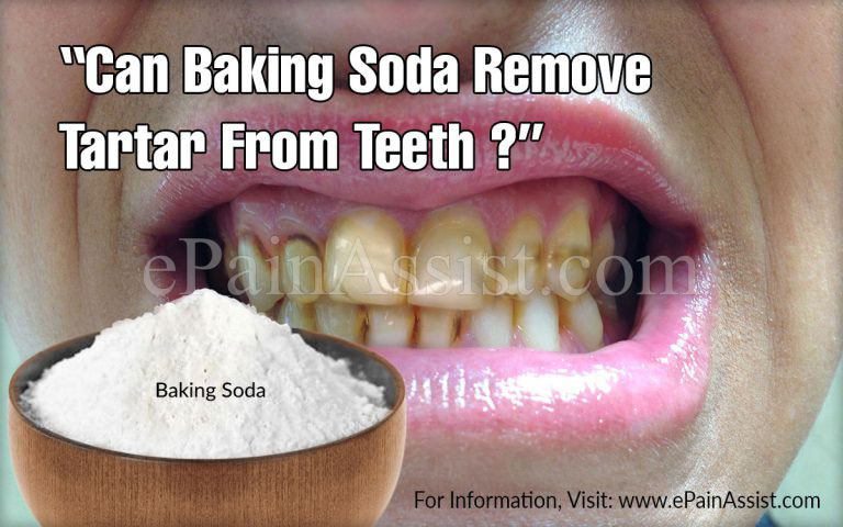Can Baking Soda Remove Tartar From Teeth & What are the  Home Remedies To Prevent Tartar?