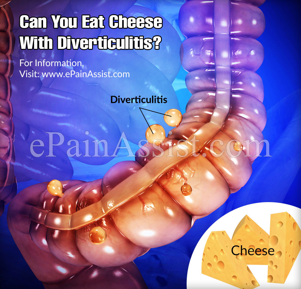 Can You Eat Cheese With Diverticulitis?