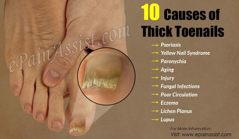 10 Causes of Thick Toenails & 11 Home Remedies To Get Rid Of it