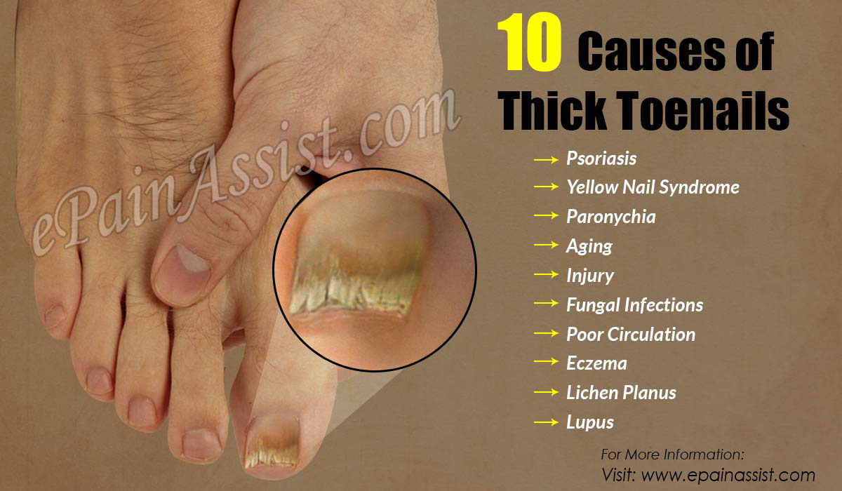 10 Causes of Thick Toenails