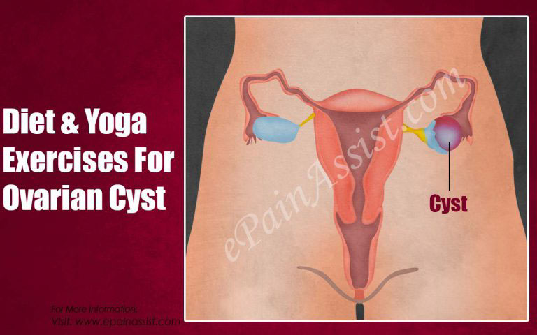 Diet & Yoga Exercises For Ovarian Cyst