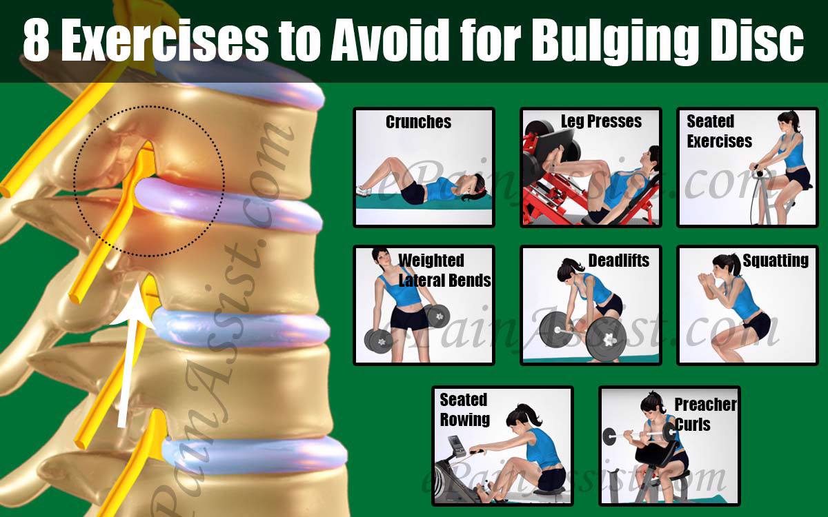 8 Exercises to Avoid for Bulging Disc