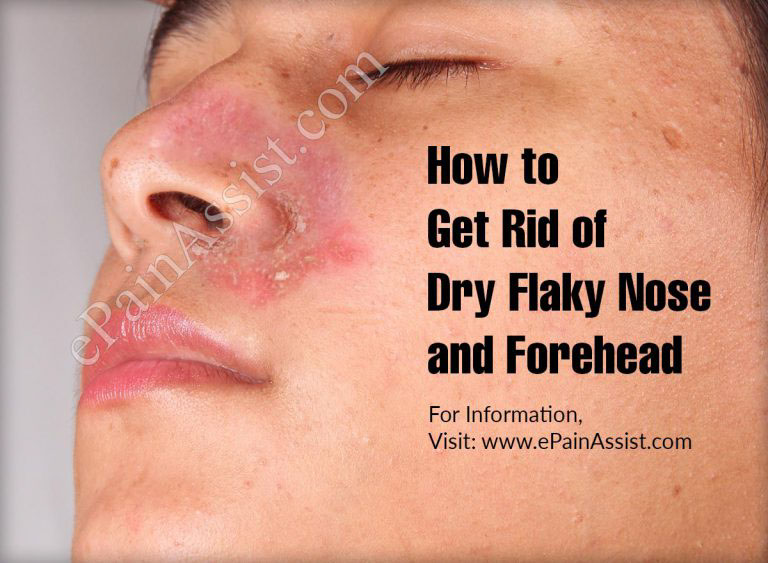 Get Rid of Dry Flaky Nose and Forehead  With These  Effective Ways & Home Remedies