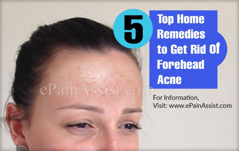 5 Top Home Remedies to Get Rid of Forehead Acne