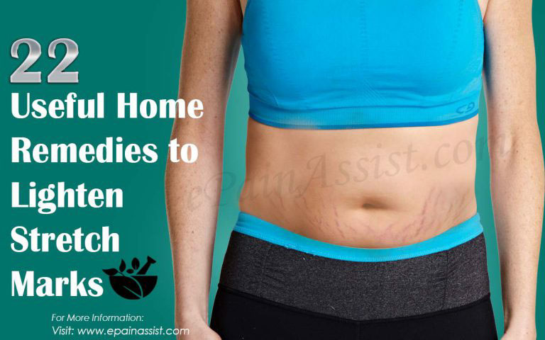 22 Useful Home Remedies to Lighten Stretch Marks