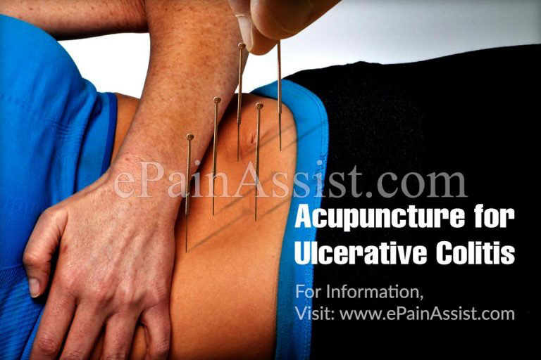 Acupuncture for Ulcerative Colitis: Can it Help?