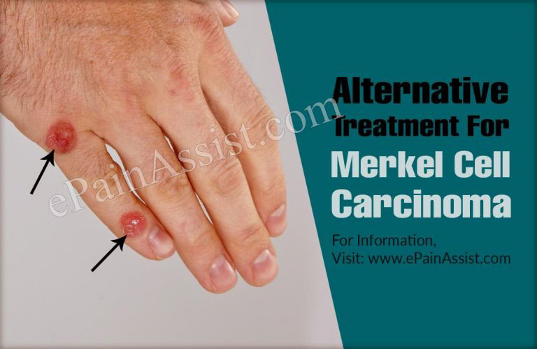 Alternative Treatment For Merkel Cell Carcinoma & Is It A Progressive Disease?