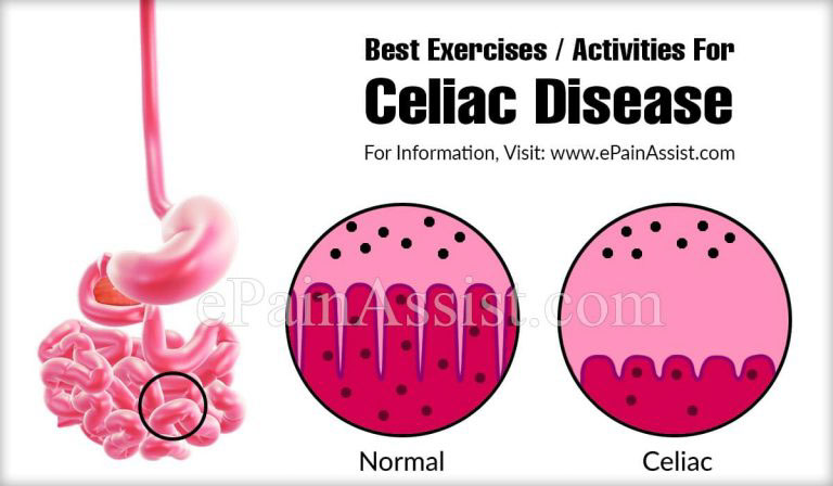Best Exercises/Activities For Celiac Disease
