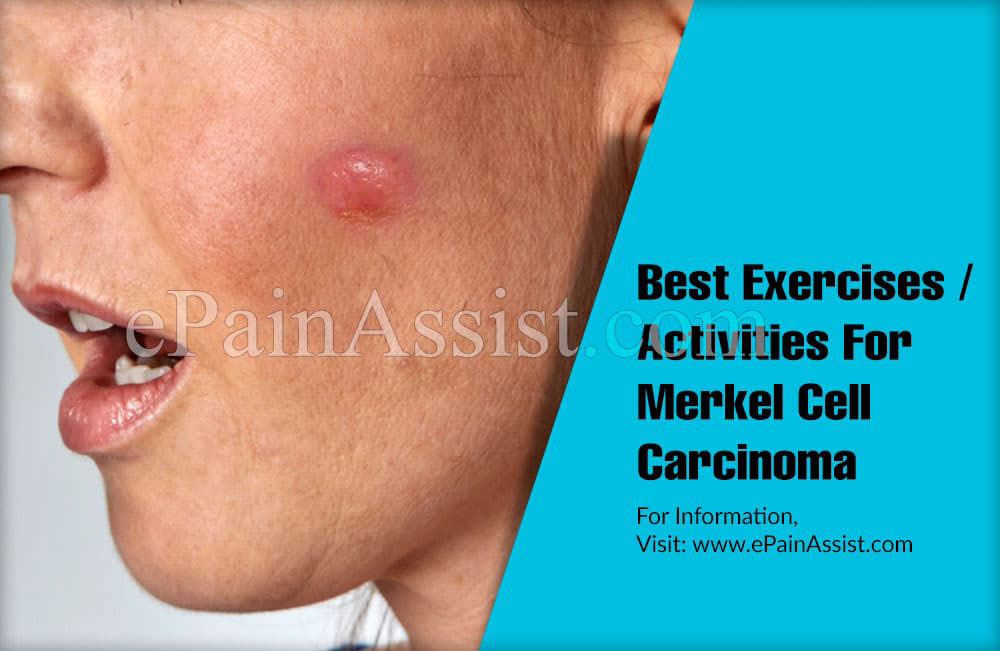 Best Exercises/Activities For Merkel Cell Carcinoma