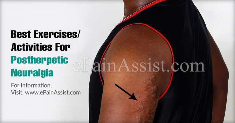 Best Exercises/Activities For Postherpetic Neuralgia