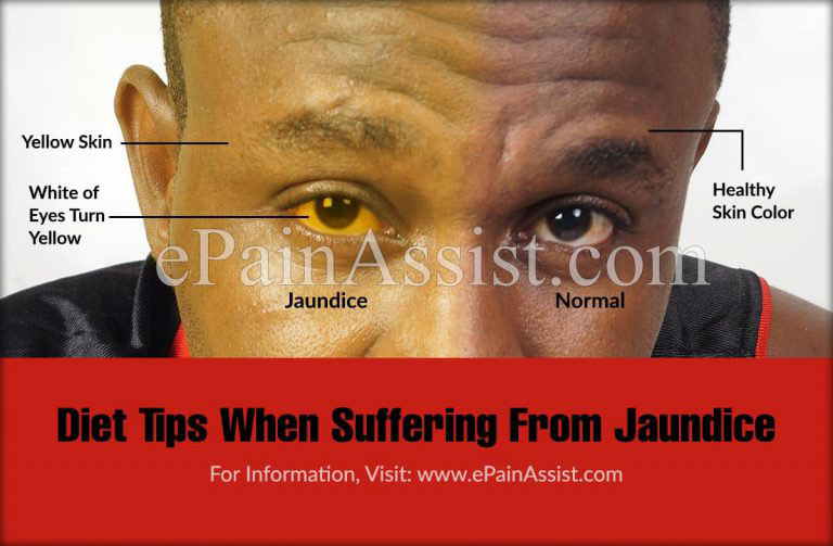 Diet Tips When Suffering From Jaundice
