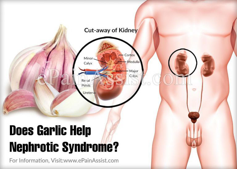 Does Garlic Help Nephrotic Syndrome & What About Ginger?