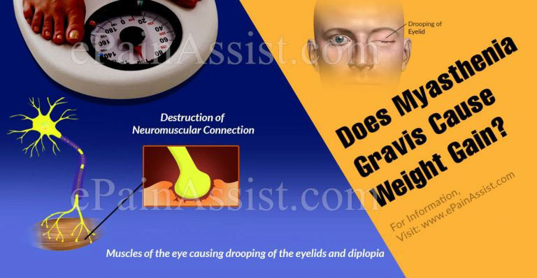 Does Myasthenia Gravis Cause Weight Gain?