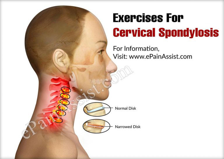 Exercises For Cervical Spondylosis: Flexibility, Isometric and Stretching Exercises