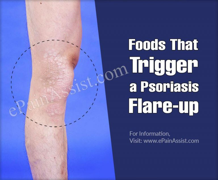Foods That Trigger a Psoriasis Flare-up