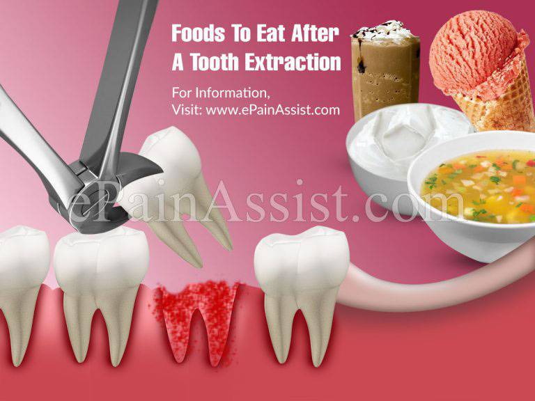 Foods To Eat After A Tooth Extraction