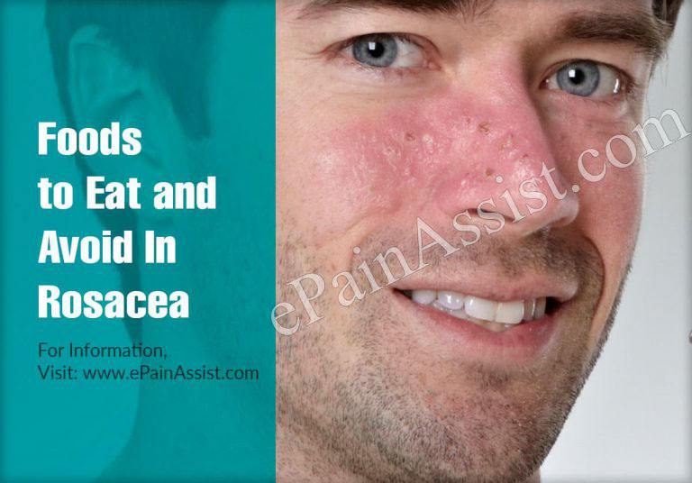 Foods to Eat and Avoid In Rosacea