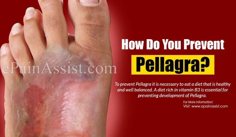 How Do You Prevent Pellagra?