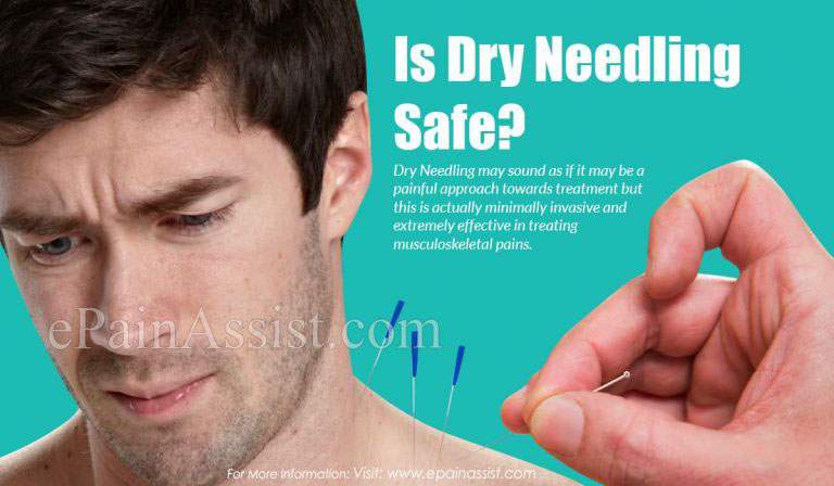 Is Dry Needling Safe & What Are The Benefits?