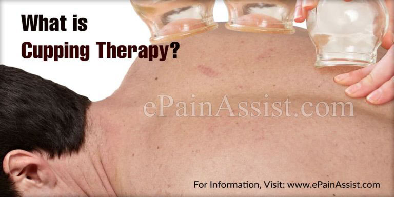 What is Cupping Therapy & Health Conditions Treated With Cupping Therapy?|Types and Side Effects Of Cupping Therapy