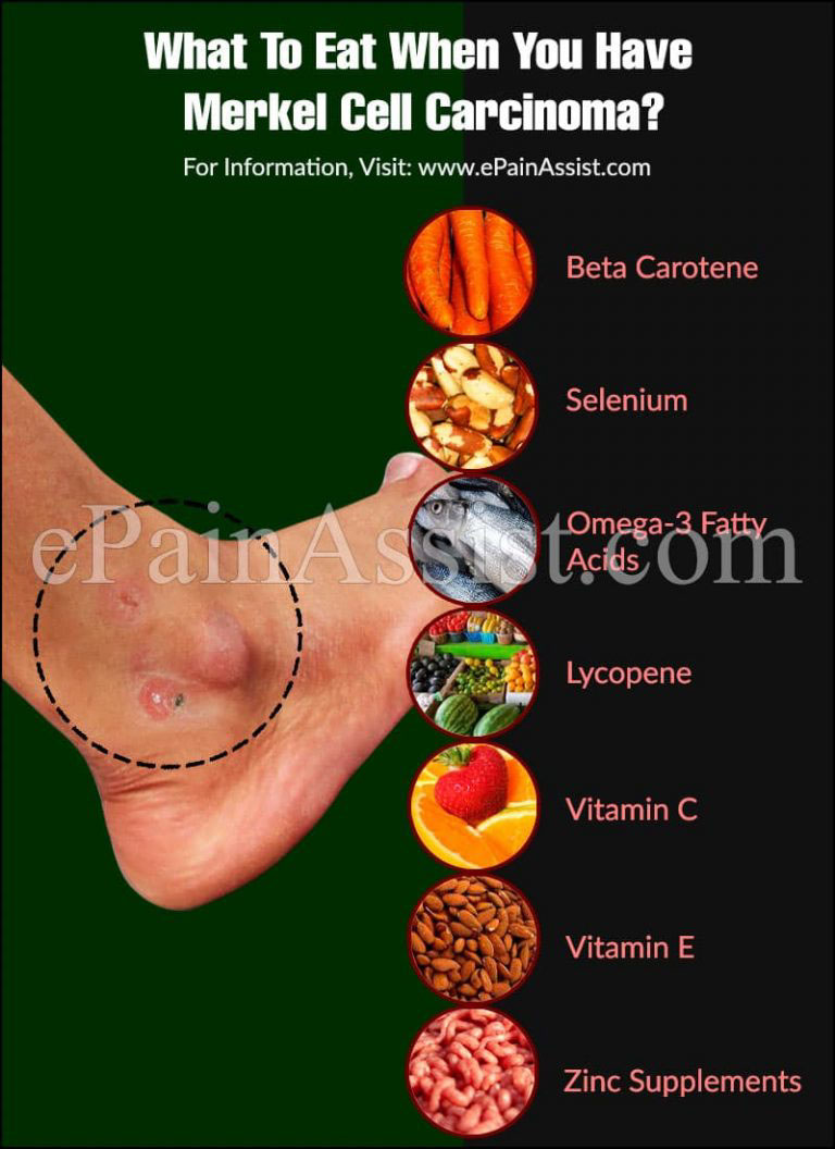 What To Eat When You Have Merkel Cell Carcinoma?