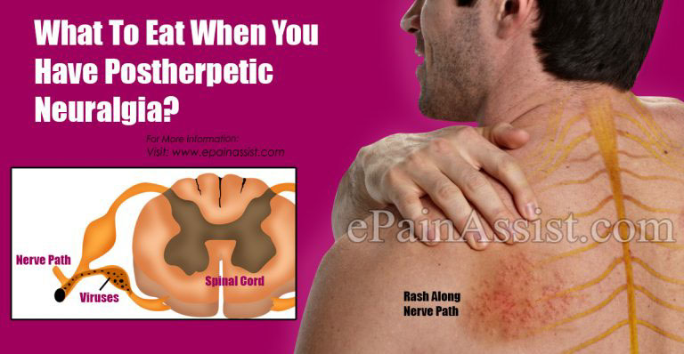 What To Eat & Avoid When You Have Postherpetic Neuralgia?