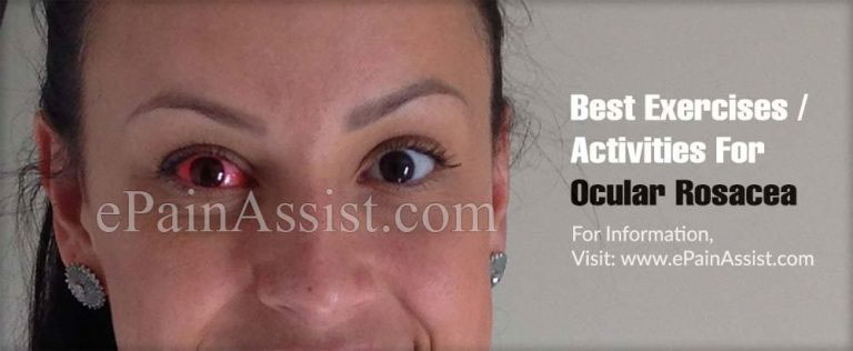 Best Exercises/Activities For Ocular Rosacea